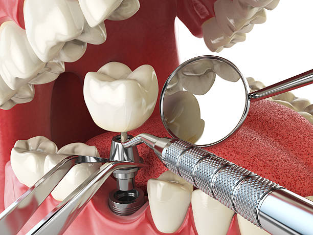 Best Urgent Care for Lost Fillings or Crowns in Woodbury Center, CT